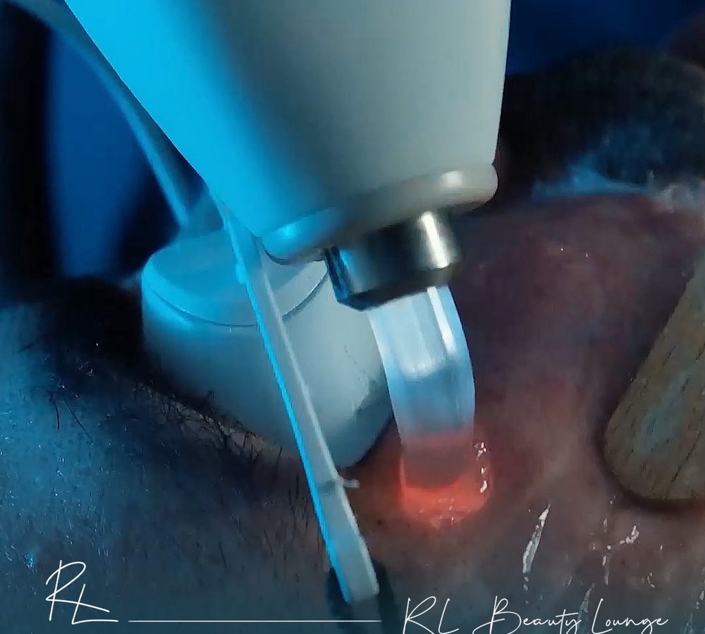 Alma Soprano ICE Titanium lazer epilasyon başlığı — RL Beauty Lounge Ankara